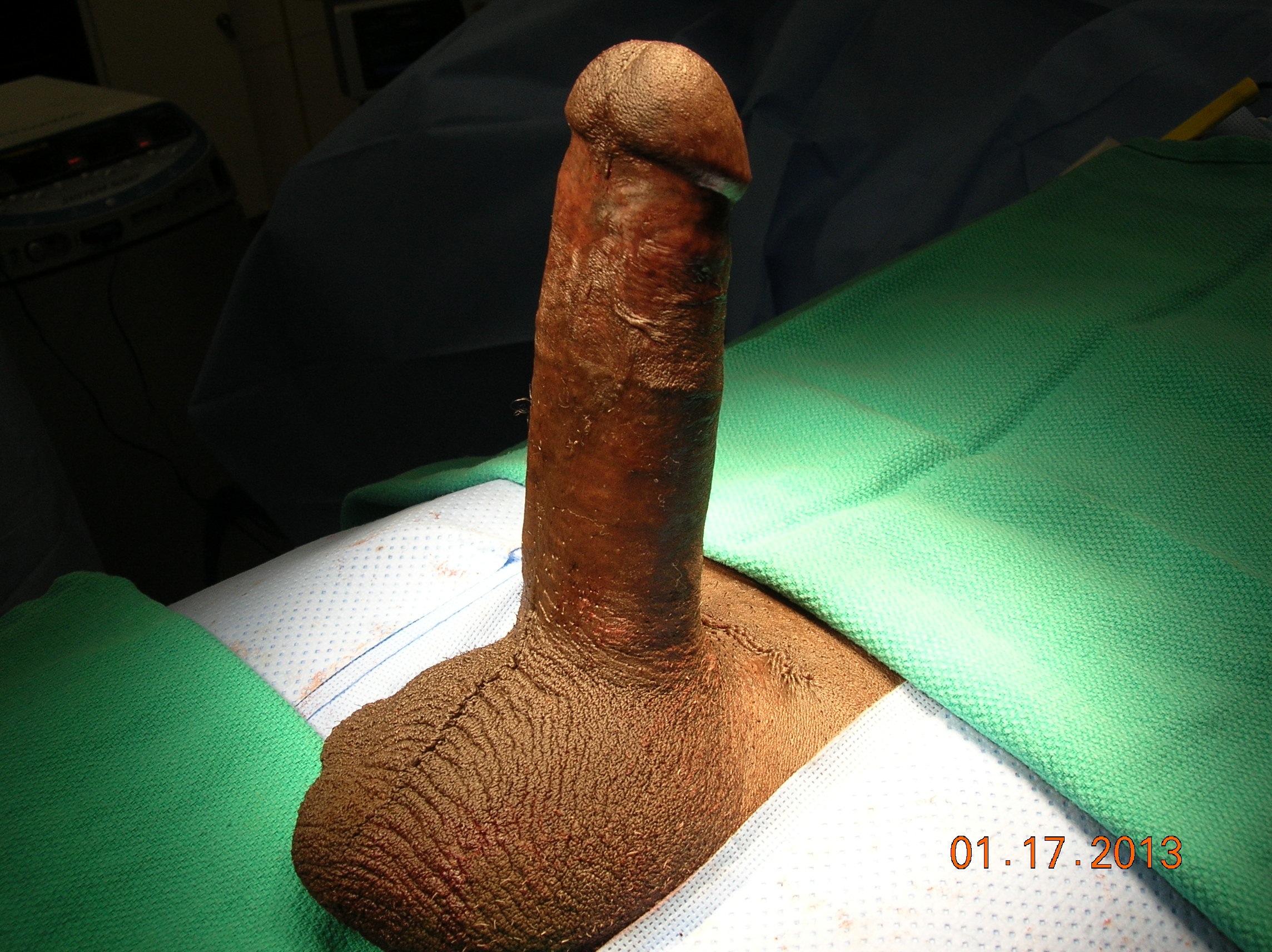 Maximum Penile Length & Girth by Dr. Garber